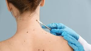 Mole Removal Laser Treatment: Benefits and Risks